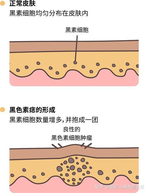 好的痣|痣也可能会癌变！长在 3 个地方要注意